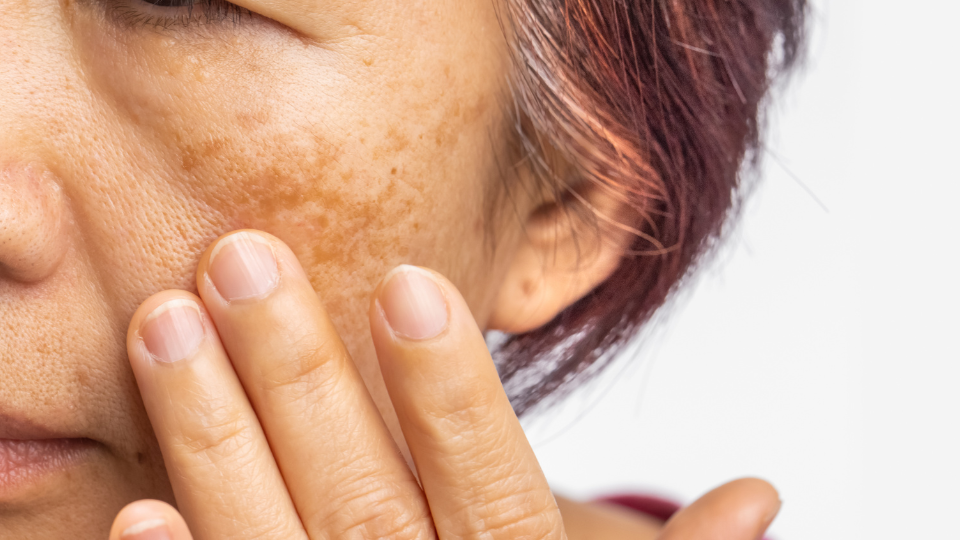 Recommended care for Pekas or Melasma